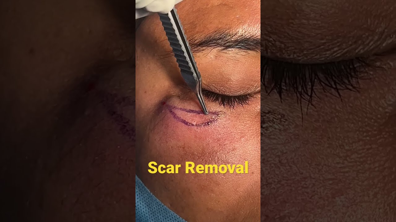 Scar Removal By Plastic Surgery
