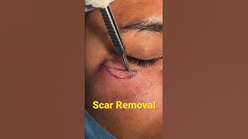 Scar Removal by plastic Surgery