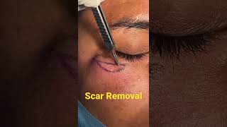 Scar Removal by plastic Surgery