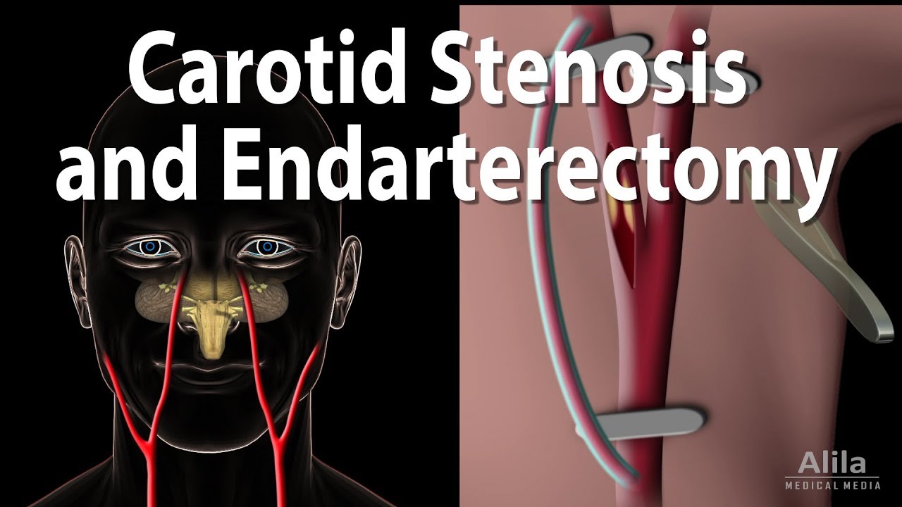 How To Pronounce Carotid Endarterectomy