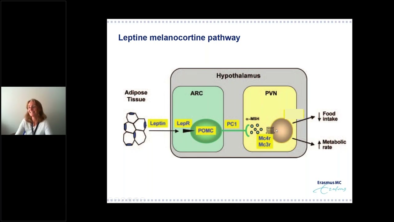 Genetic Obesity Disorders caused by Leptin melanocortin Pathway Defects