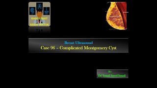 Ultrasound Case 96 Complicated Montgomery Cyst