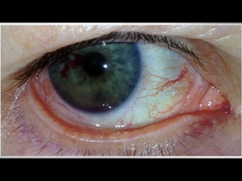 Krew w przedniej komorze oka (krwistek)