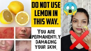 Stop ❎ using lemon in this way |? it can cause permanent skin damage | chemical burn, pigmentation