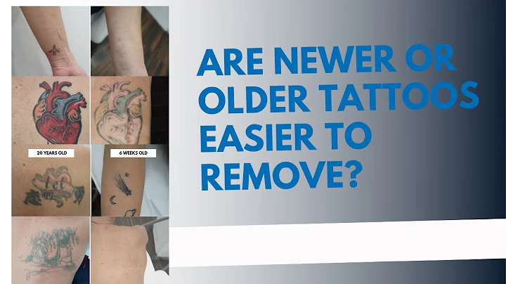 Is it easier to remove older or newer tattoos? (2023)