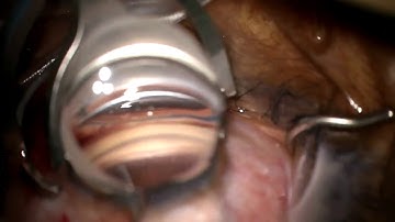 Jella An, MD: Kahook Dual Blade® (KDB) Power Wash Technique Utilizing OVD