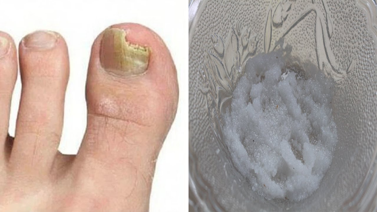 Tratament naturist pentru infecțiile de la unghiile piciorului • Buna Ziua Iasi • avanselasesoria.es