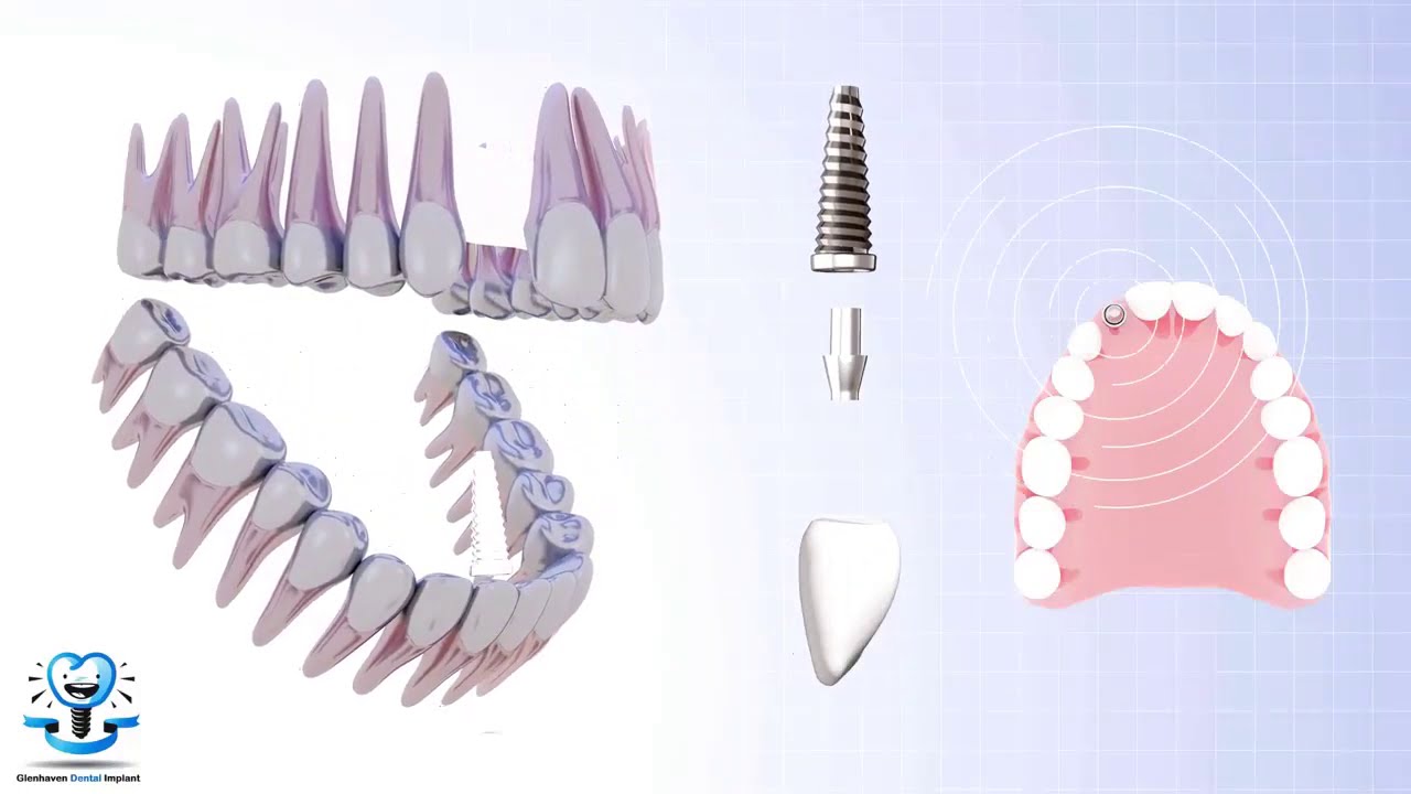 Dental Implant procedure YouTube