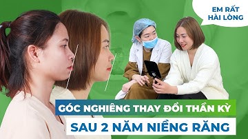"Xin Nhẹ" Cái "Góc Nghiêng Thần Thánh" Sau Khi Kết Thúc Niềng Răng Hô