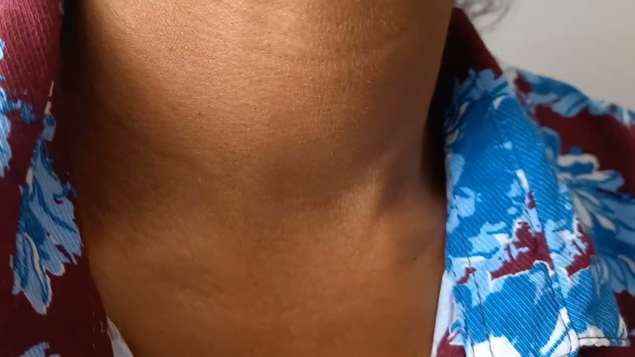 Dancing carotid sign