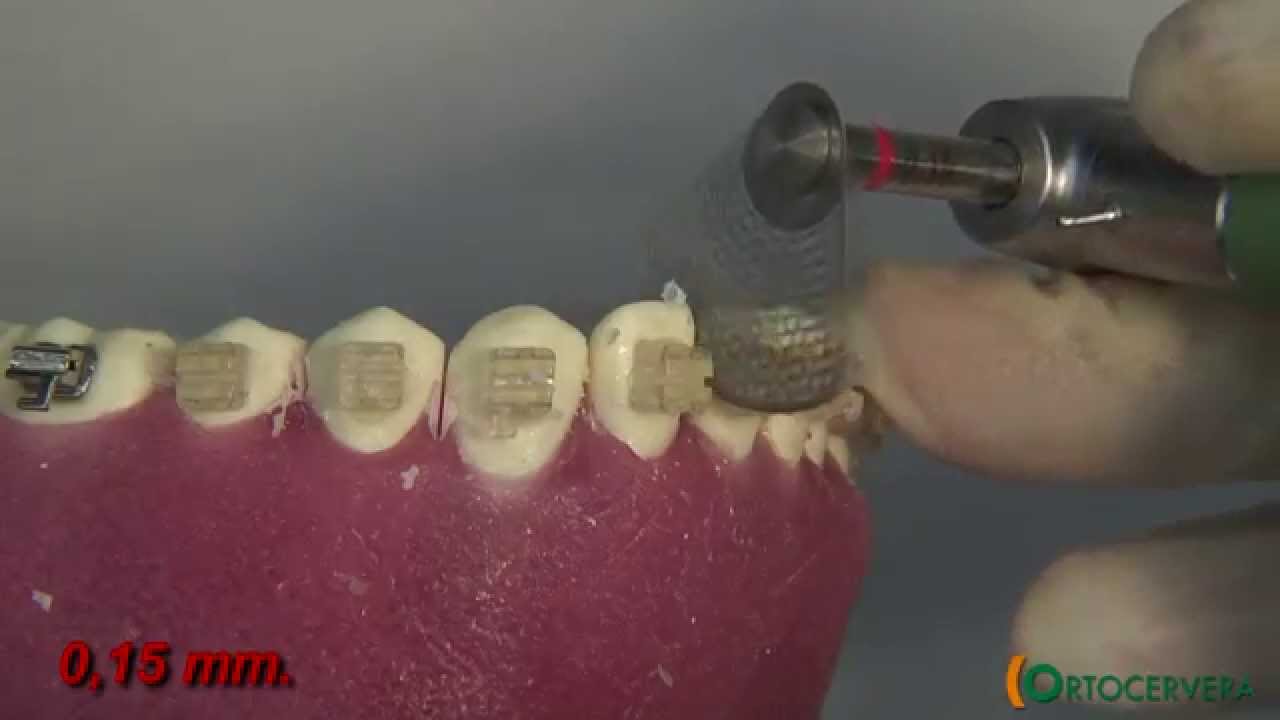 ORTOCERVERA / Ortodoncia: Stripping - Nivelación y Alineación