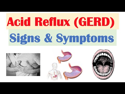 Video: Acid Reflux Symptoms: Časté A Závažné