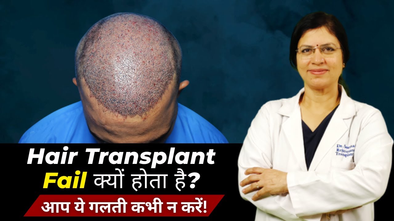 90% लोग Hair Transplant के बाद यही गलती करते हैं! जानिए सही Care क्या है! Dr Seema Garg Explained!