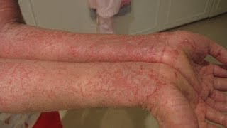 DermTV - What is Eczema [DermTV.com Epi #173]