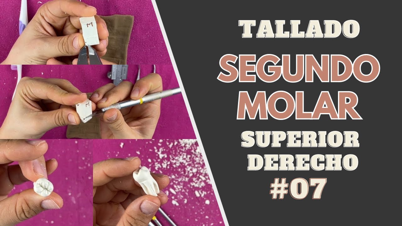 Tallado en cera de segundo molar superior derecho | Odontologia con Cri