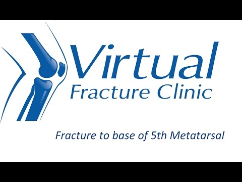 Fracture to the Base of the 5th Metatarsal