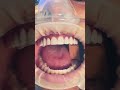 Oh My Tooth 😍 #shorts #short #subscribe