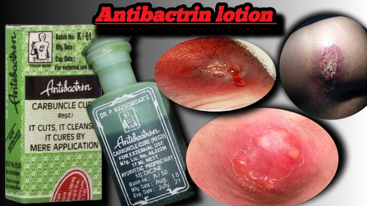 Применение антибактринового масла на хинди // Как использовать антибактриновое масло // Как вылеч...