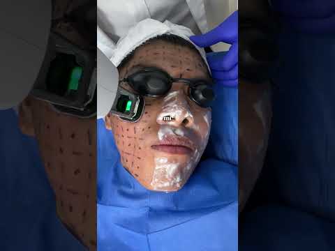 Láser Accure para tratar el acné activo #acne