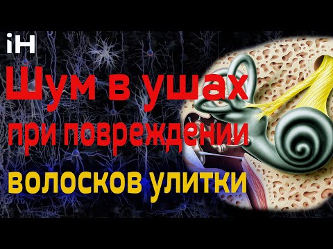 Повреждение волосков улитки внутреннего уха  - частая причина шума в ушах | iНЕВРОЛОГ