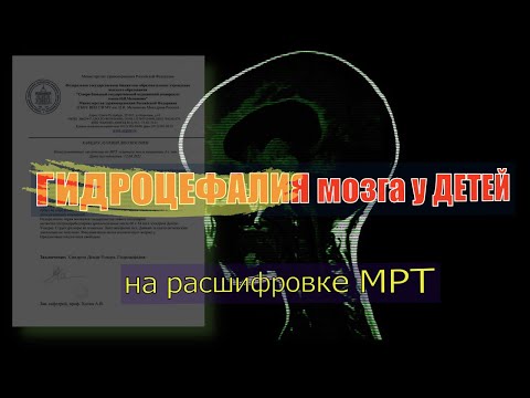 ГИДРОЦЕФАЛИЯ головного мозга у детей на РАСШИФРОВКЕ МРТ. СИНДРОМ ДЕНДИ УОКЕРА Syndrome Dandy Walker.