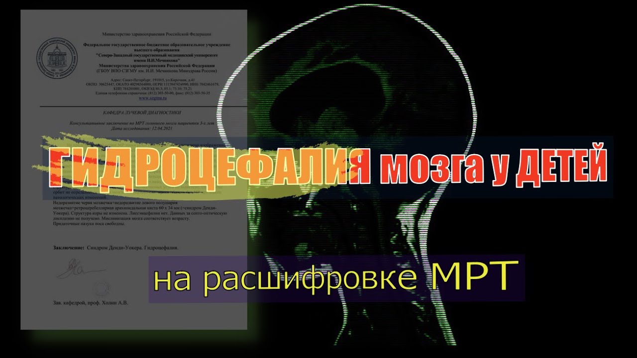 ГИДРОЦЕФАЛИЯ головного мозга у детей на РАСШИФРОВКЕ МРТ. СИНДРОМ ДЕНДИ УОКЕРА Syndrome Dandy Walker.