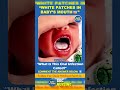 👶 White Patches in Baby’s Mouth | पहचानो यह Infection 😷📚#childhealthnursing #education