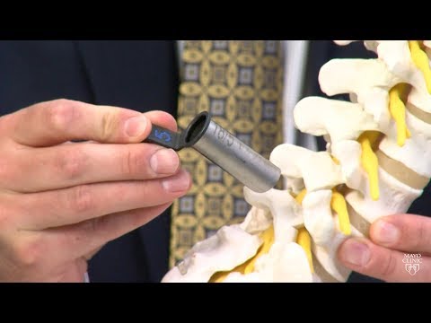 Video: Surgery To Remove A Herniated Disc Of The Spine - Indications, Consequences, Types Of Surgery