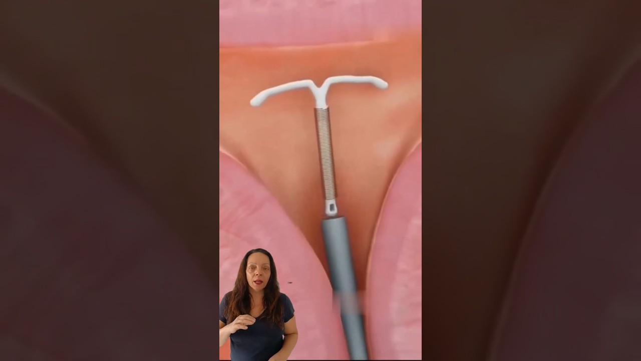 DIU: Como é colocado? Veja e entenda TUDO sobre o procedimento! 