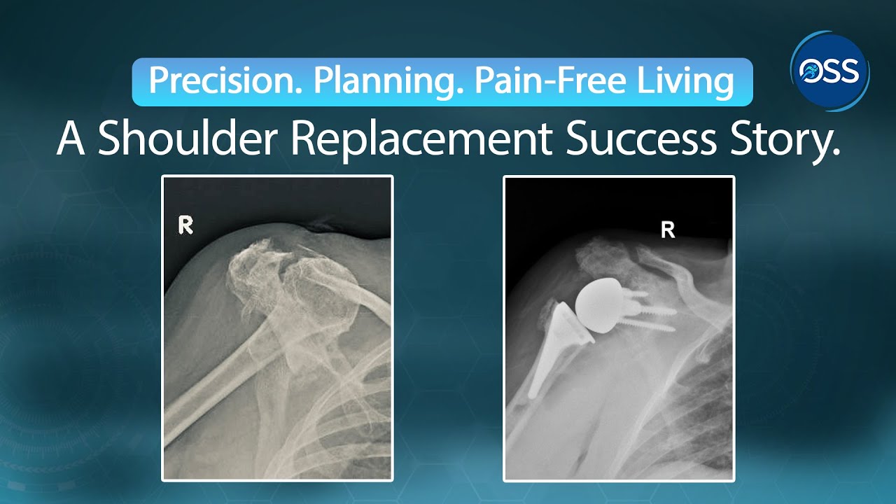 From Pain to Precision | Successful Shoulder Surgery for Severe Arthritis & Bone Loss
