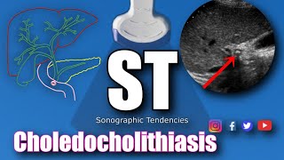 Sonoquickies - Choledocholithiasis
