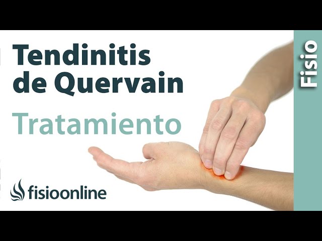 Tendinitis de De Quervain - Tratamiento con ejercicios, automasajes y estiramientos