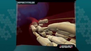 SPECTRALIS NSite Analytics™ Imaging Software for Neurology