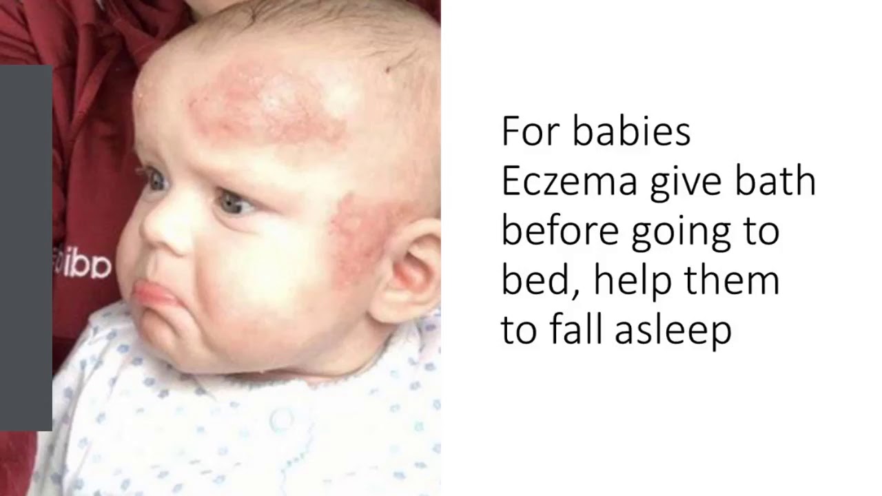 How To Treat Eczema Naturally : Top Home Remedies For Eczema 