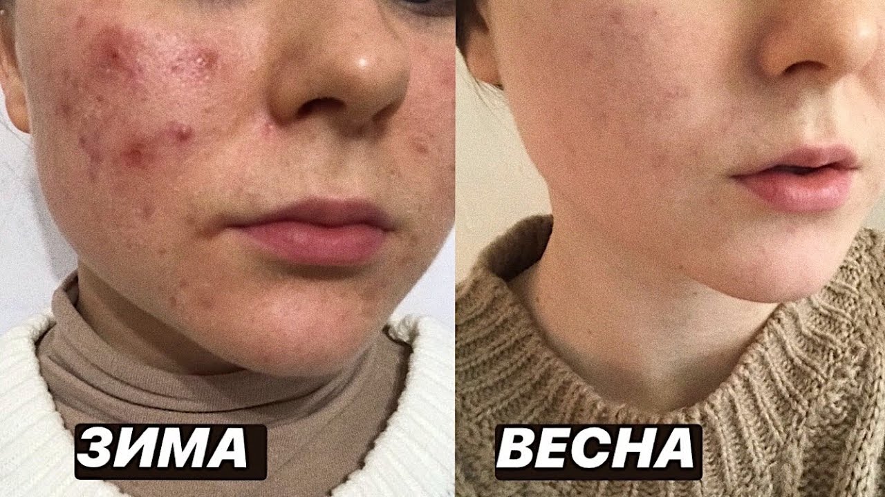 Как я Избавилась от Акне // Опыт Лечение Уход - YouTube