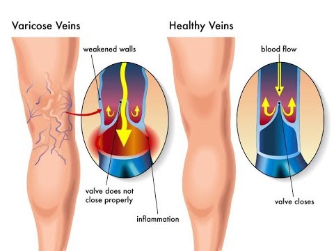 get rid of spider veins naturally get rid of spider veins naturally