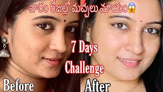 7 Days Challenge - Remove Pimple Marks & Acne Scars Naturally at Home | మొటిమలు మచ్చలు తగ్గాలంటే? screenshot 5