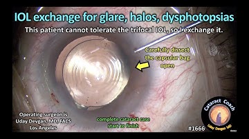 CataractCoach™ 1666: IOL exchange for glare, halos, dysphotopsias