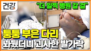 "무심코 넘긴 퉁증과 붓기" 급사까지 유발하는 혈관 속 시한폭탄 혈전증｜혈전증 부르는 식습관과 생활습관｜혈전증 종류와 치료법｜명의｜#EBS건강