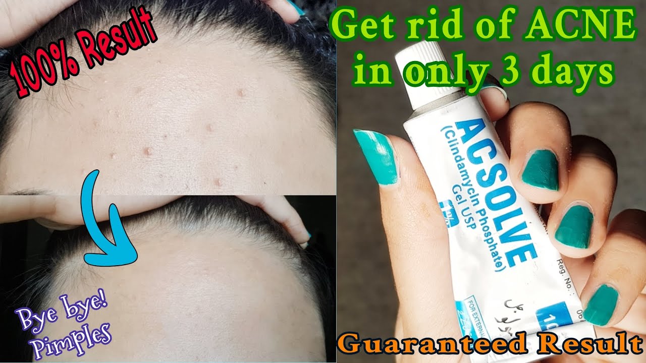 Remove Acne/Pimples Fast in 3 days Only Acsolve Gel Review Get rid