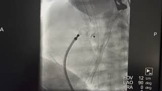 DRRAVIRT - PRETERM PDA DEVICE CLOSURE USING PICOLLO PDA DEVICE
