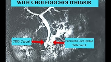 ERCP in Chronic Calcific Pancreatitis with Chiledocholithiasis