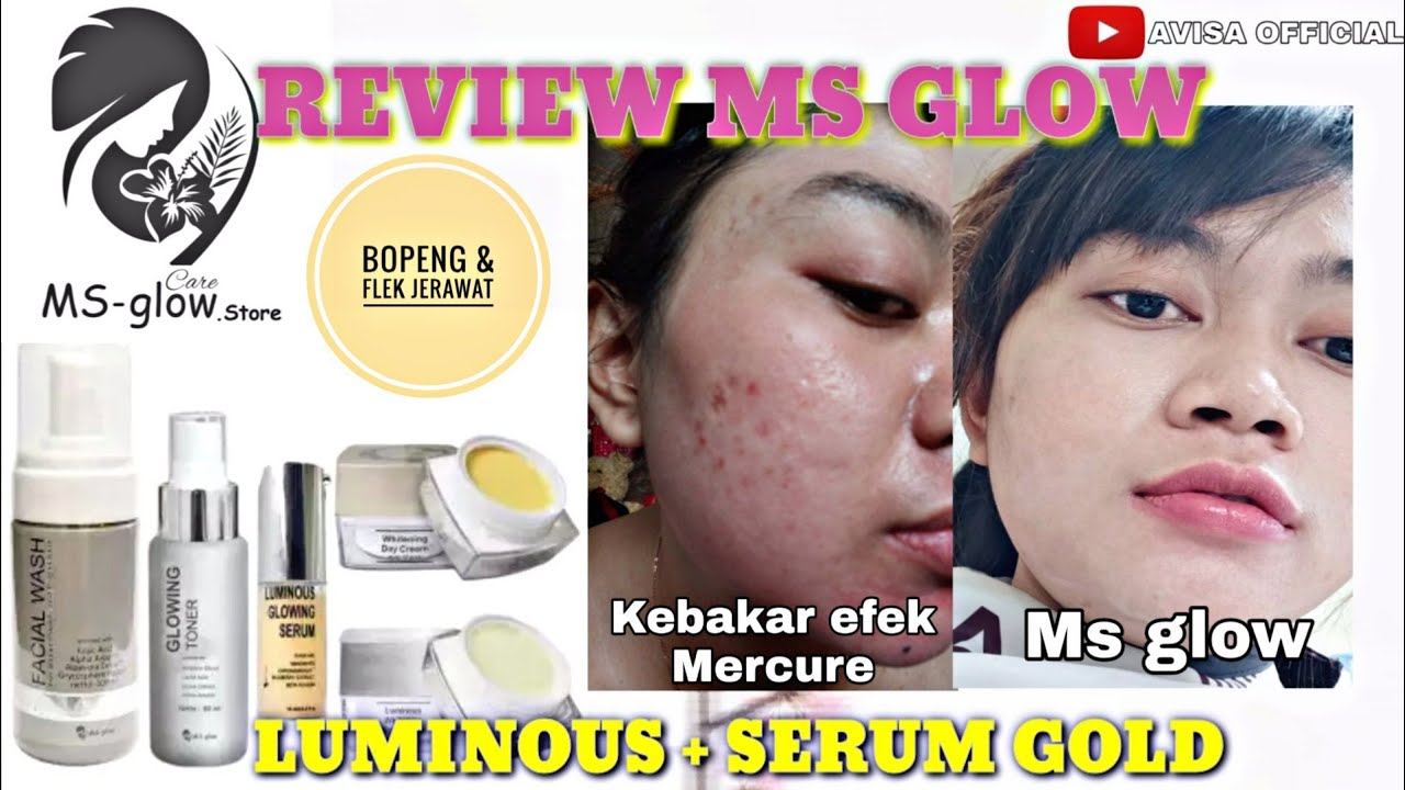 REVIEW PEMAKAIAN MS GLOW LUMINOUS (Bopeng+Flek Jerawat