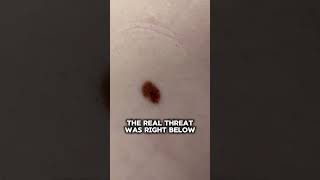 This patient was concerned about this crusted spot, and scheduled a skin exam to have it evaluated