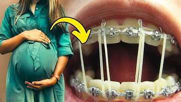 ✅ MANG THAI Đi Niềng Răng NGUY HIỂM KHÔNG?