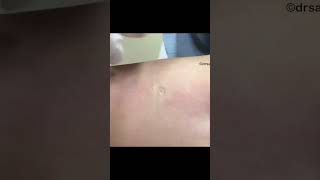 This was hiding under the skin! @DrPimplePopper