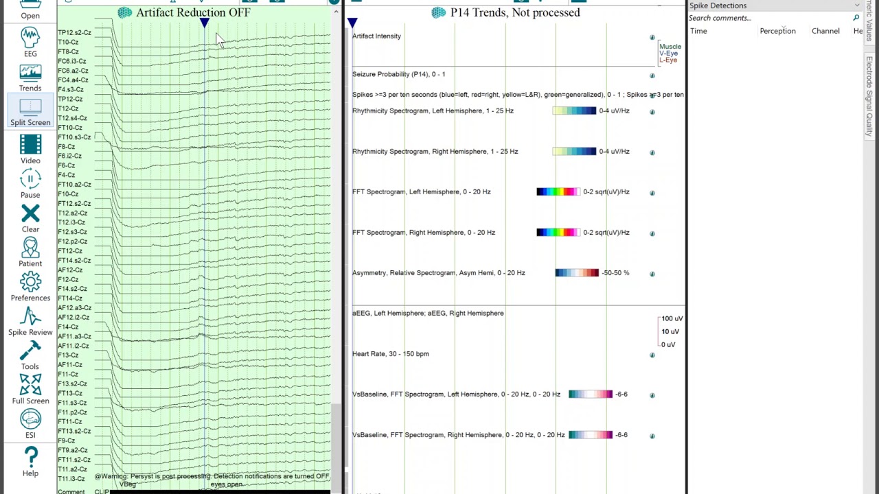 Persyst 14 Applying 1010 Channel Maps and Processing EGI 256 EEG YouTube