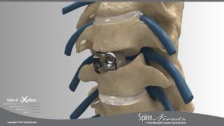 Ceres-C Stand-alone ACDF, anterior cervical discectomy and fusion, MIS procedure