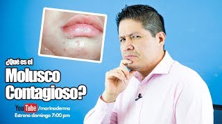 WHAT IS CONTAGIOUS MOLLUSCUM? II NEW VIDEO