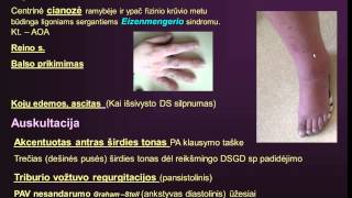 sergant hipertenzija, gydymas liaudies gynimo priemonėmis